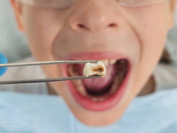 Best Emergency Root Canal Treatment in Fruitland, MD